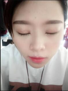 双眼皮和开眼角慢慢恢复