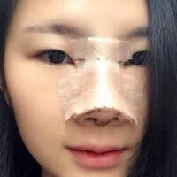 膨体隆鼻整形价格11800元，隆鼻果和恢复过程分享