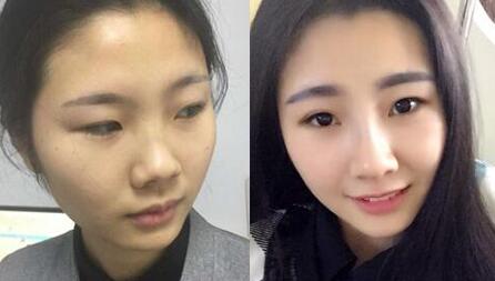 膨体隆鼻手术前后对比图