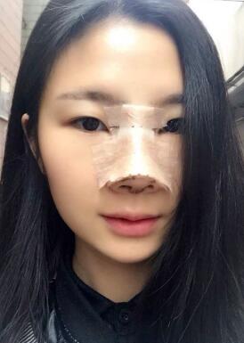 膨体隆鼻手术图片和过程分享