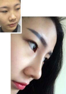 假体隆鼻前后对比照片