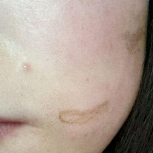 两次激光祛疤过程图片分享给大家做割参考