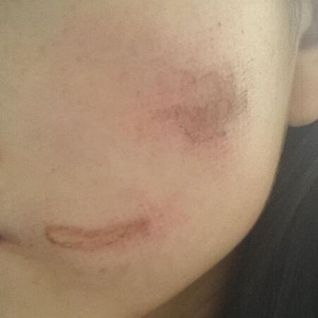 两次激光祛疤过程图片分享给大家做割参考