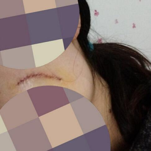 给大家看看我的脸上的手术切除祛疤过程图片