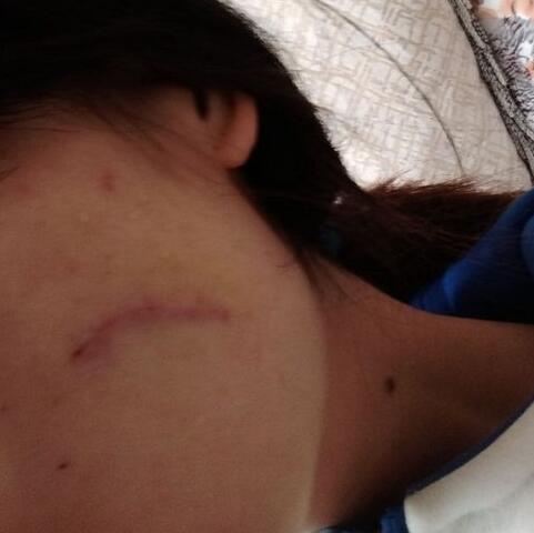 给大家看看我的脸上的手术切除祛疤过程图片