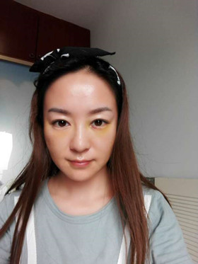 蛋白线面部埋埋蛋白线.提升，改良我的皮肤问题