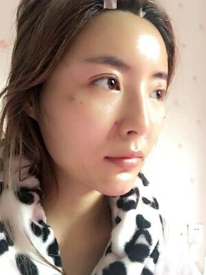 自体脂肪全脸填充之后脸变小了也更精致了