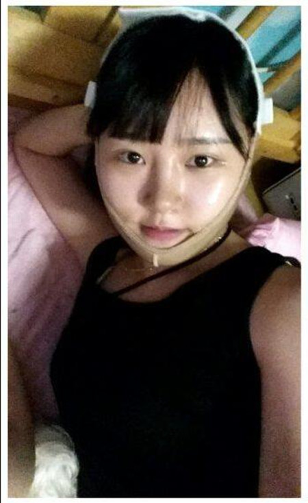 做了下颌角整形手术 大脸猫变成巴掌脸果还不错哦