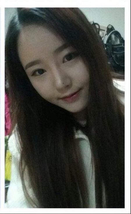 做了下颌角整形手术 大脸猫变成巴掌脸果还不错哦