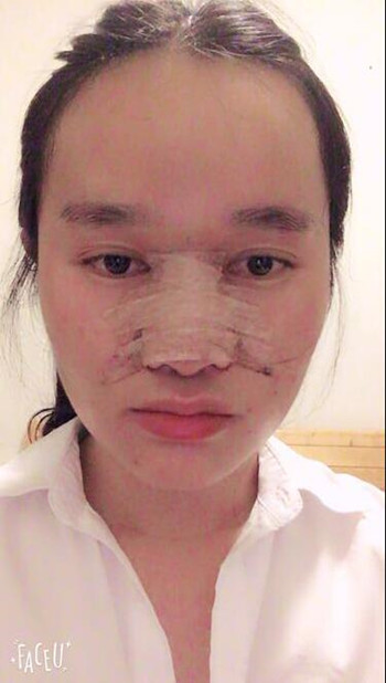 做了隆鼻整形手术整个鼻子灵巧了许多 快来围观果
