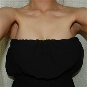 去年底做了自体脂肪丰胸手术，分享术后果照片~