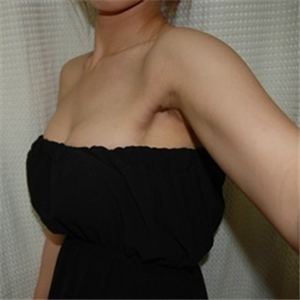 去年底做了自体脂肪丰胸手术，分享术后果照片~