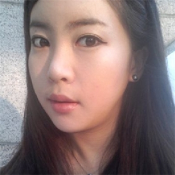 分享美立方做下颌角整形手术经历，还有前后对比果图片哦~