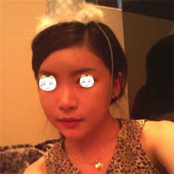 分享美立方做下颌角整形手术经历，还有前后对比果图片哦~