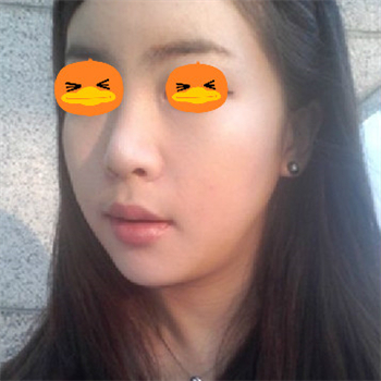 分享美立方做下颌角整形手术经历，还有前后对比果图片哦~