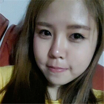 艺星做的玻尿酸去法令纹，分享恢复过程和前后对比照片~