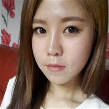 艺星做的玻尿酸去法令纹，分享恢复过程和前后对比照片~