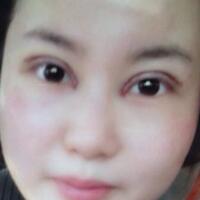 割双眼皮和开内眼角一起做了，护理了近一个月完全恢复自然