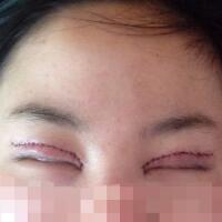 割双眼皮和开内眼角一起做了，护理了近一个月完全恢复自然