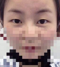 全切双眼皮和开内眼角手术恢复过程分享