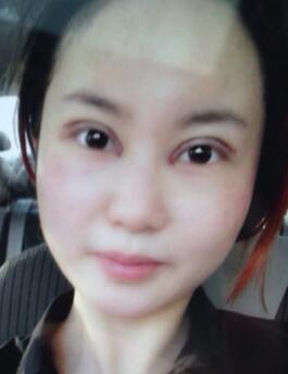 割双眼皮整形图片