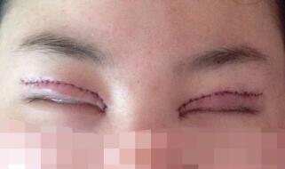 双眼皮多项整形整形图片