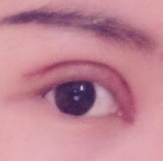 全切双眼皮和开眼角