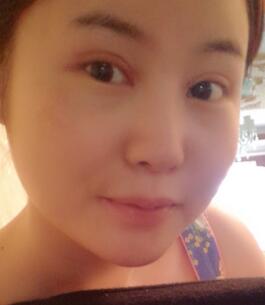 全切双眼皮和开眼角半个月了