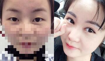 割双眼皮和开眼角的手术果对比图