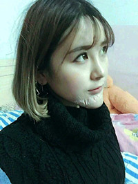 自体脂肪垫下巴前后手术过程以及对比恢复照片分享