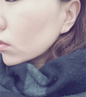 电波l皮紧肤除皱，的确是年轻了不少