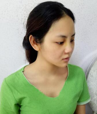 深圳晨曦隆鼻整形半年了 看看果