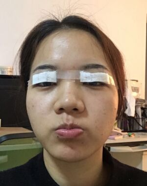为了美丽大眼做了切开双眼皮，果令我惊叹