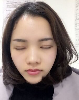 为了美丽大眼做了切开双眼皮，果令我惊叹