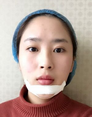 深圳美莱整形医院做了进口硅胶垫下巴脸型都变好看了