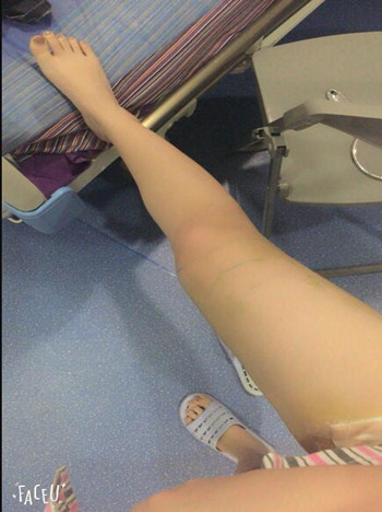 冯斌帮我做的大腿吸脂 果真的很棒