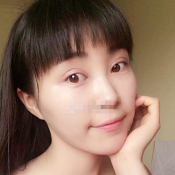 开外眼角手术一个月了，分享恢复过程和前后对比果照片~