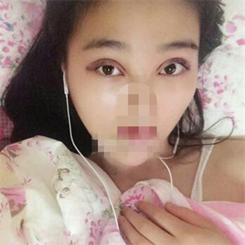 开外眼角手术一个月了，分享恢复过程和前后对比果照片~