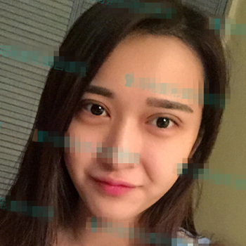 伊美馨做了开内眼角和双眼皮手术，分享我的术后果照片~~