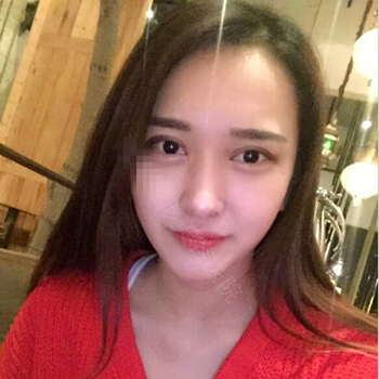 伊美馨做了开内眼角和双眼皮手术，分享我的术后果照片~~