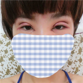 双眼皮失败修复手术前后对比果图片分享，伊美馨做的哦·