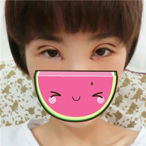 双眼皮失败修复手术前后对比果图片分享，伊美馨做的哦·