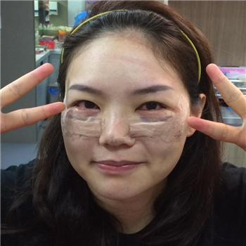 李阿姨眼袋失败修复手术后的果图，年轻了好几岁~