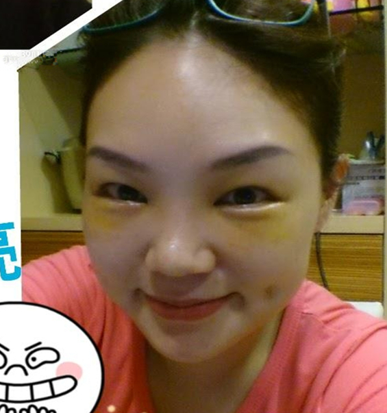 李阿姨眼袋失败修复手术后的果图，年轻了好几岁~