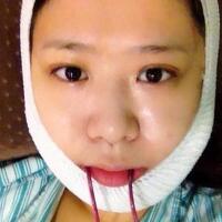 磨下颌角整形——恢复3个月后真实磨骨案例分享