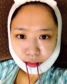 磨骨，下颌角整形照片