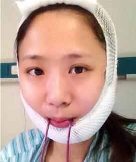 下颌角整形照片