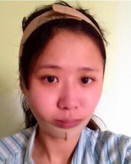 磨下颌角手术图片