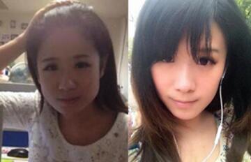 磨下颌角前后对比图