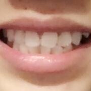 美容冠牙齿修复，缓解前后过程分享